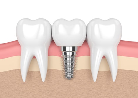 Dental Implants Sydney | Dental Pro Gladesville & Bossley Park